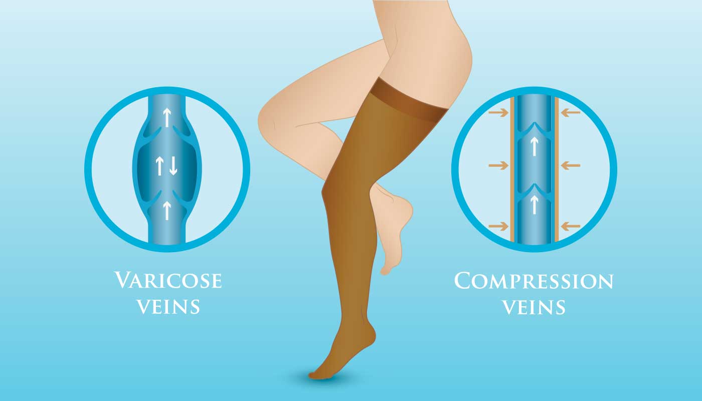 Compression Stockings for Varicose Veins - Miami Vein Center